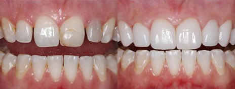 Porcelain Veneers