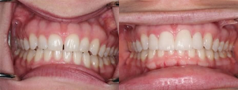 Porcelain Veneers