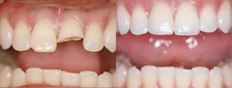 Porcelain Veneers