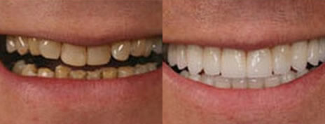 Porcelain Crowns & Veneers