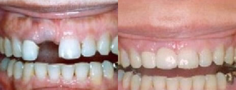 Dental Implants