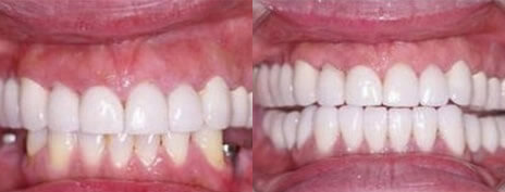 Dental Implants