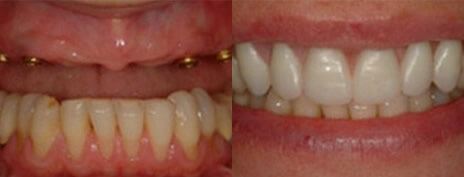 Denture Stabilization
