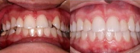 Invisalign® Invisible Braces