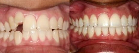 Invisalign® Invisible Braces