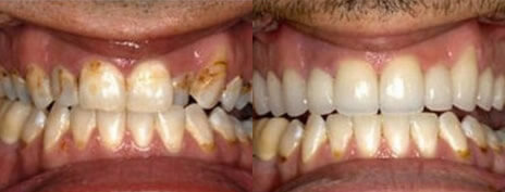 Invisalign® Invisible Braces