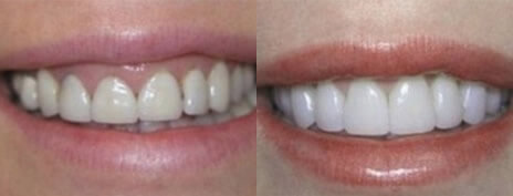 Gum Recontouring
