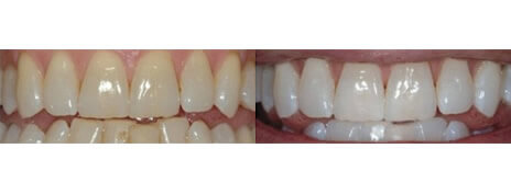 Whitening
