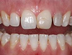 Porcelain Veneers