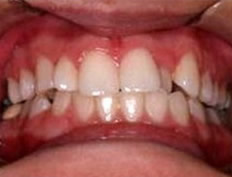 Invisalign Invisible Braces