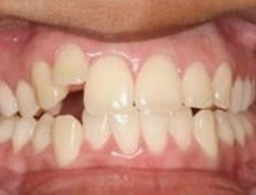 Invisalign Invisible Braces