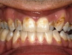 Invisalign Invisible Braces