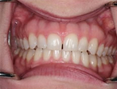 Porcelain Veneers