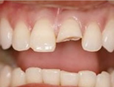 Porcelain Veneers