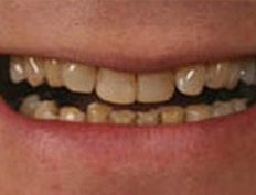 Porcelain Crowns & Veneers