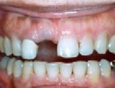 Dental Implants