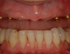 Denture Stabilization