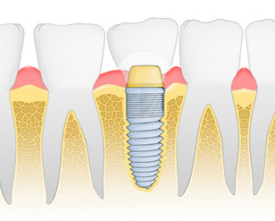 implants